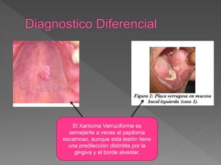 El Xantoma Verruciforme es
semejante a veces al papiloma
escamoso, aunque esta lesión tiene
una predilección distintita por la
gingiva y el borde alveolar.
 