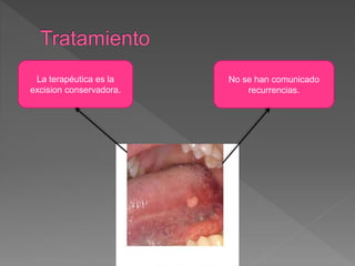 La terapéutica es la
excision conservadora.
No se han comunicado
recurrencias.
 