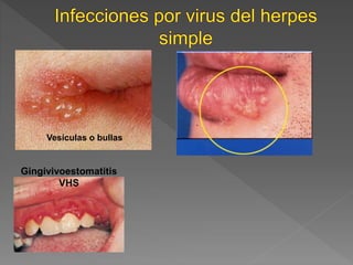 Vesículas o bullas
Gingivivoestomatitis
VHS
 