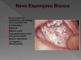  Es un trastorno
autosómico dominante
de la mucosa oral.
 Asintomatico
 Bilateral
 Blanco o gris
 Frecuentemente como
una gruesa placa
 textura esponjosa
 corrugado o
aterciopelada

 