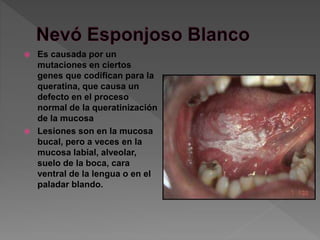 Es causada por un
mutaciones en ciertos
genes que codifican para la
queratina, que causa un
defecto en el proceso
normal de la queratinización
de la mucosa
 Lesiones son en la mucosa
bucal, pero a veces en la
mucosa labial, alveolar,
suelo de la boca, cara
ventral de la lengua o en el
paladar blando.
 