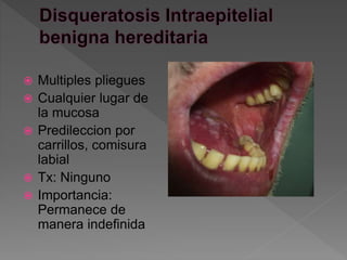  Multiples pliegues
 Cualquier lugar de
la mucosa
 Predileccion por
carrillos, comisura
labial
 Tx: Ninguno
 Importancia:
Permanece de
manera indefinida
 