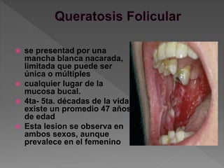  se presentad por una
mancha blanca nacarada,
limitada que puede ser
única o múltiples
 cualquier lugar de la
mucosa bucal.
 4ta- 5ta. décadas de la vida,
existe un promedio 47 años
de edad
 Esta lesion se observa en
ambos sexos, aunque
prevalece en el femenino
 