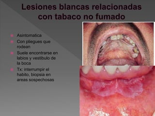  Asintomatica
 Con pliegues que
rodean
 Suele encontrarse en
labios y vestibulo de
la boca
 Tx: interrumpir el
habito, biopsia en
areas sospechosas
 