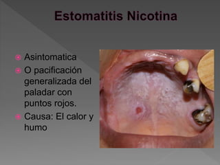  Asintomatica
 O pacificación
generalizada del
paladar con
puntos rojos.
 Causa: El calor y
humo
 