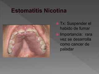  Tx: Suspender el
habido de fumar
 Importancia: rara
vez se desarrolla
como cancer de
paladar
 