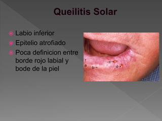  Labio inferior
 Epitelio atrofiado
 Poca definicion entre
borde rojo labial y
bode de la piel
 