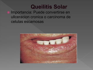  Importancia: Puede convertirse en
ullceracion cronica o carcinoma de
celulas escamosas
 