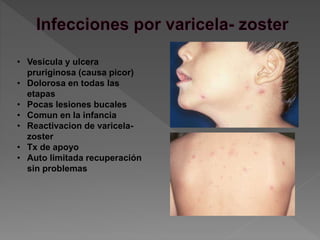 • Vesicula y ulcera
pruriginosa (causa picor)
• Dolorosa en todas las
etapas
• Pocas lesiones bucales
• Comun en la infancia
• Reactivacion de varicela-
zoster
• Tx de apoyo
• Auto limitada recuperación
sin problemas
 