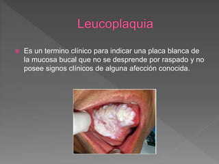  Es un termino clínico para indicar una placa blanca de
la mucosa bucal que no se desprende por raspado y no
posee signos clínicos de alguna afección conocida.
 