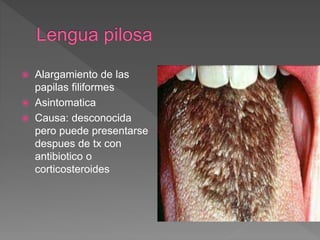  Alargamiento de las
papilas filiformes
 Asintomatica
 Causa: desconocida
pero puede presentarse
despues de tx con
antibiotico o
corticosteroides
 