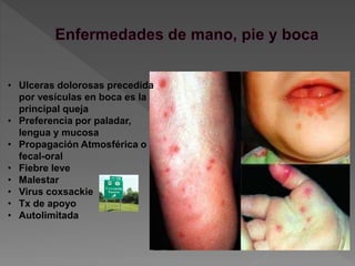 • Ulceras dolorosas precedida
por vesículas en boca es la
principal queja
• Preferencia por paladar,
lengua y mucosa
• Propagación Atmosférica o
fecal-oral
• Fiebre leve
• Malestar
• Virus coxsackie
• Tx de apoyo
• Autolimitada
 