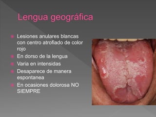  Lesiones anulares blancas
con centro atrofiado de color
rojo
 En dorso de la lengua
 Varia en intensidas
 Desaparece de manera
espontanea
 En ocasiones dolorosa NO
SIEMPRE
 