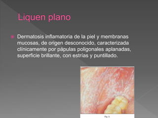  Dermatosis inflamatoria de la piel y membranas
mucosas, de origen desconocido, caracterizada
clínicamente por pápulas poligonales aplanadas,
superficie brillante, con estrías y puntillado.
 