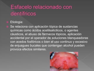  Etiologia:
 Se relaciona con aplicación tópica de sustancias
químicas como ácidos acetilsalicilicos, o agentes
cáusticos, el abuso de fármacos tópicos, aplicación
accidental por el operador de soluciones blanqueadoras
con acedos fosfóricos o bien el uso continuo y excesivo
de enjuagues bucales que contengan alcohol pueden
provoca efectos similares.
 