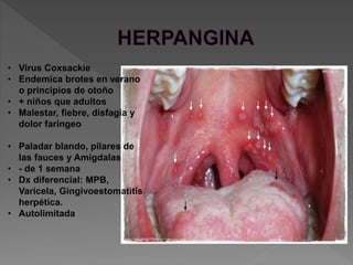 • Virus Coxsackie
• Endemica brotes en verano
o principios de otoño
• + niños que adultos
• Malestar, fiebre, disfagia y
dolor faríngeo
• Paladar blando, pilares de
las fauces y Amígdalas
• - de 1 semana
• Dx diferencial: MPB,
Varicela, Gingivoestomatitis
herpética.
• Autolimitada
 