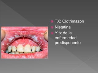  TX: Clotrimazon
 Nistatina
 Y tx de la
enfermedad
predisponente
 
