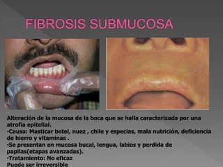 Alteración de la mucosa de la boca que se halla caracterizada por una
atrofia epitelial.
•Causa: Masticar betel, nuez , chile y especias, mala nutrición, deficiencia
de hierro y vitaminas .
•Se presentan en mucosa bucal, lengua, labios y perdida de
papilas(etapas avanzadas).
•Tratamiento: No eficaz
Puede ser irreversible
 