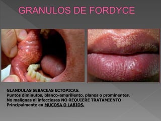 GLANDULAS SEBACEAS ECTOPICAS.
Puntos diminutos, blanco-amarillento, planos o prominentes.
No malignas ni infecciosas NO REQUIERE TRATAMIENTO
Principalmente en MUCOSA O LABIOS.
 