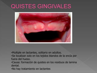 •Multiple en lactantes, solitario en adultos.
•Se localizan solo en los tejidos blandos de la encía por
fuera del hueso.
•Causa: formación de quistes en los residuos de lamina
dental.
•No hay tratamiento en lactantes
 
