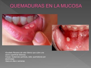 •Exudado fibrosino de color blanco que cubre una
ulcera superficial dolorosa.
•Causa: Sustancias químicas, calor, quemaduras por
electricidad.
•Sana en días o semanas
 