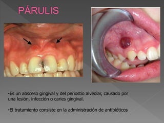 •Es un absceso gingival y del periostio alveolar, causado por
una lesión, infección o caries gingival.
•El tratamiento consiste en la administración de antibióticos
 