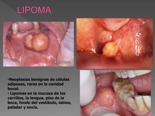 •Neoplasias benignas de células
adiposas, raras en la cavidad
bucal.
• Lipomas en la mucosa de los
carrillos, la lengua, piso de la
boca, fondo del vestíbulo, labios,
paladar y encía.
 