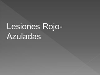 Lesiones Rojo-
Azuladas
 