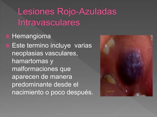  Hemangioma
 Este termino incluye varias
neoplasias vasculares,
hamartomas y
malformaciones que
aparecen de manera
predominante desde el
nacimiento o poco después.
 