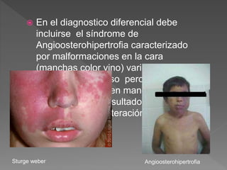  En el diagnostico diferencial debe
incluirse el síndrome de
Angioosterohipertrofia caracterizado
por malformaciones en la cara
(manchas color vino) varices e
hipertrofia de hueso pero también
pueden aparecer en mandíbula o
maxila. Y como resultado de este hay
mala oclusión y alteración de la
erupción dental.
Sturge weber Angioosterohipertrofia
 