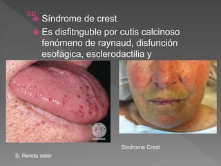  Síndrome de crest
 Es disfitnguble por cutis calcinoso
fenómeno de raynaud, disfunción
esofágica, esclerodactilia y
telangiectasia
S. Rendu osler
Sindrome Crest
 