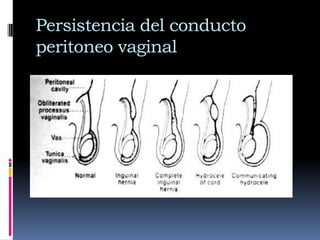 Es un divertículo que se extiende a través del anillo inguinal interno