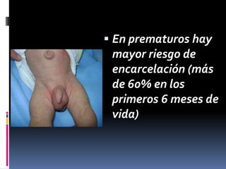 Persistencia del conducto peritoneo vaginal