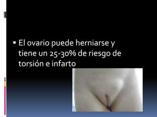 GeneralidadesHernia inguinal es una de las patologías quirúrgicas más frecuentes