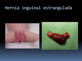 El ovario puede herniarse y tiene un 25-30% de riesgo de torsión e infarto