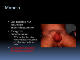 Examen FísicoSigno del guante de seda:  engrosamiento al palpar el cordón espermático al cruzar el tubérculo púbicoEl diagnóstico se hace con la HC y EF