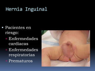 Hernia inguinal con ovario incluido