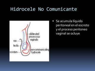 Hernia inguinal estrangulada