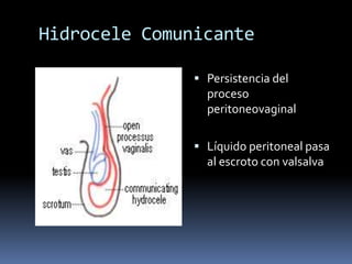 Hernia InguinalAntes de tratar de reducir una hernia hay que palpar el testículo porque la masa inguinal puede corresponder a un testículo