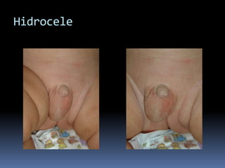 Hidrocele No ComunicanteSe acumula líquido peritoneal en el escroto y el proceso peritoneo vaginal se ocluye