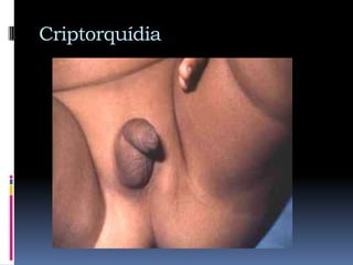 Testículo RetráctilRetracción transitoria del testículo fuera del escroto por contracción del músculo cremáster