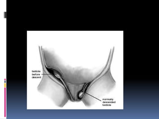 CriptorquídiaEs frecuente en pacientes con defectos de pared abdominal:Gastrosquisis	15%Onfalocele		1/3Defectos del tubo neural >1/3