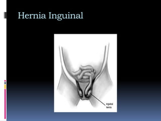 28-32 semanas se encuentran en canal inguinal