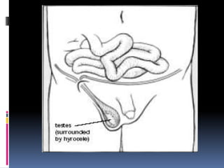 30 semanas se espera encontrar los testículos en escroto