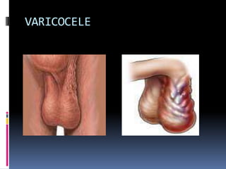 Criptorquidia Bilateral