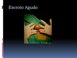 VaricoceleDEFINICION: