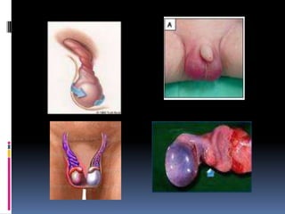 Dilatación varicosa de los vasos venosos del plexo pampiniforme del testículo