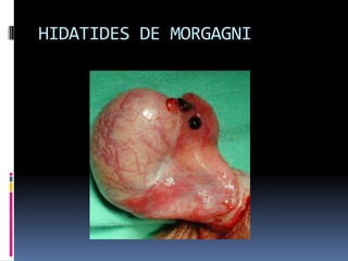 Causa frecuente de esterilidadVaricoceleDEFINICION: