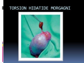 Tiene apariencia de una “bolsa de gusanos” y se palpa igual