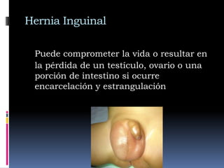 Más frecuente en el niño de pretérmino